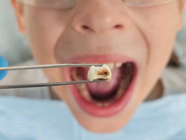 Best Emergency Dentist for Lost Fillings or Crowns in Martinez, GA